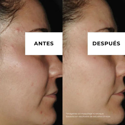 Equilibrium Anti-Akne-Creme für fettige Haut Arganour 30 ml